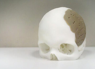 3D Printers Produce Custom Bone Implants 3d-skull-implant