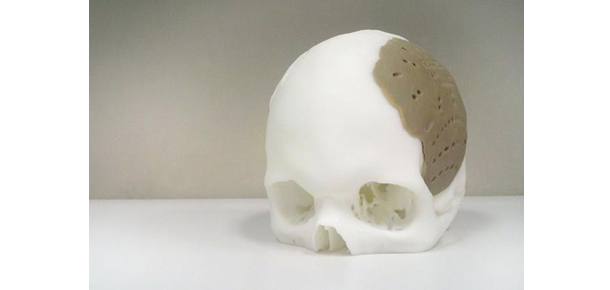 3d-skull-implant